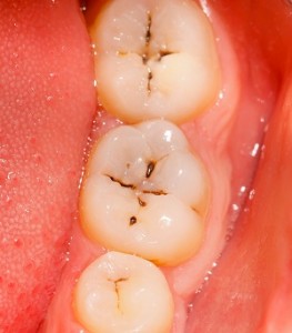 I have a cavity / tooth decay - image
